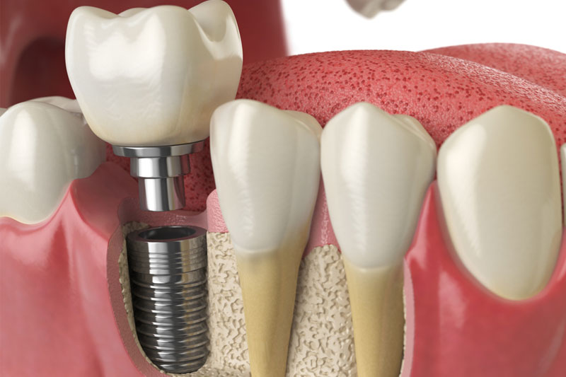 What Is Implant Treatment?