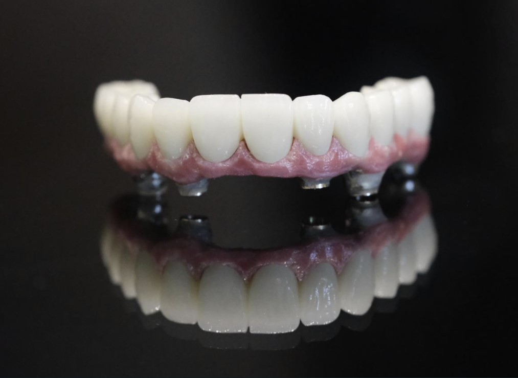 All on Four Porcelain (DTI) Per Jaw