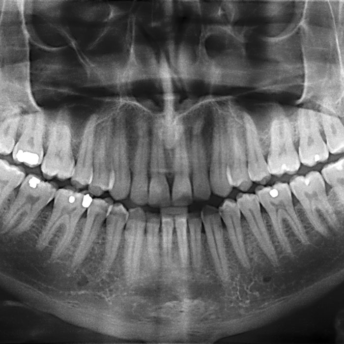 Panaromik X-Ray